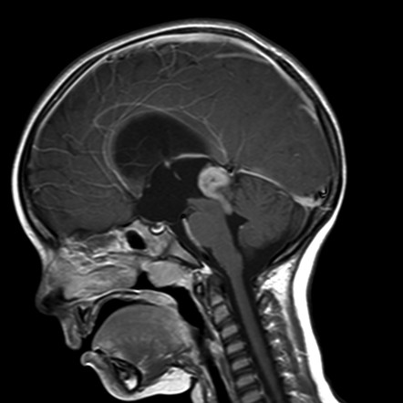 Pineoblastoma | Radiology Reference Article | Radiopaedia.org