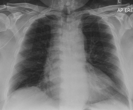 Peripherally inserted central catheter | Radiology Reference Article ...