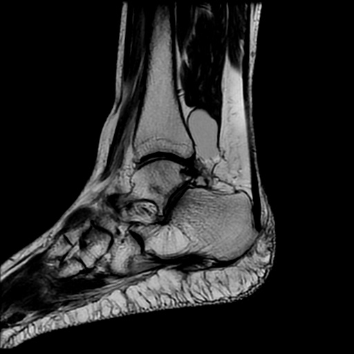 Posterior Ankle Impingement Syndrome | Image | Radiopaedia.org