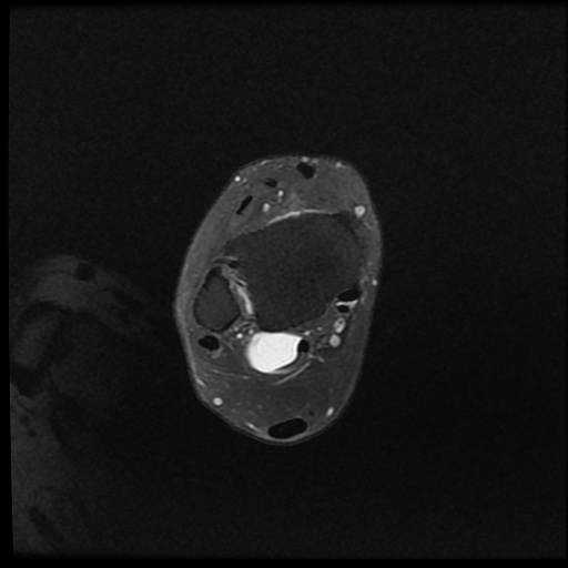 Posterior Ankle Impingement Syndrome Image