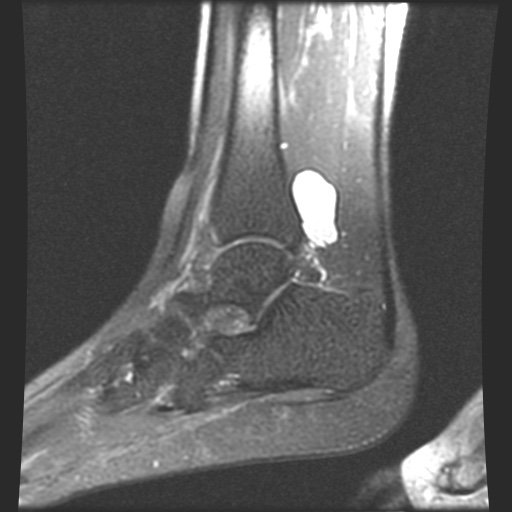 Posterior Ankle Impingement Syndrome Image