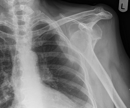 Anterior shoulder dislocation | Radiology Case | Radiopaedia.org