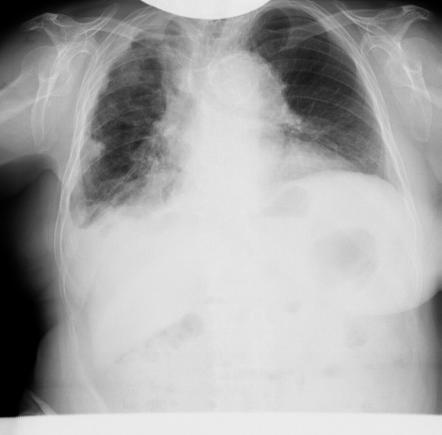 Pleural thickening | Radiology Case | Radiopaedia.org