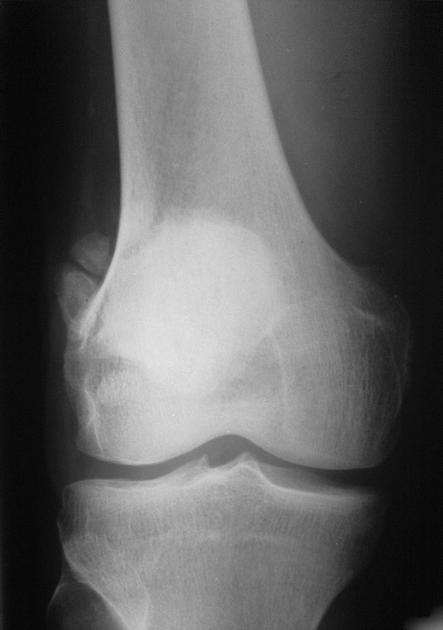 Multipartite patella | Radiology Reference Article | Radiopaedia.org