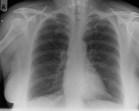 Perihilar consolidation - with follow up film resolution | Radiology ...