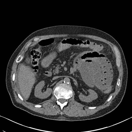 Internal hernia | Radiology Reference Article | Radiopaedia.org