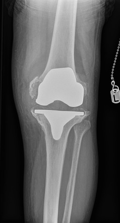 Periprosthetic fracture | Radiology Reference Article | Radiopaedia.org