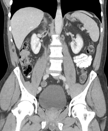 Cerebral metastasis - colorectal adenocarcinoma | Image | Radiopaedia.org