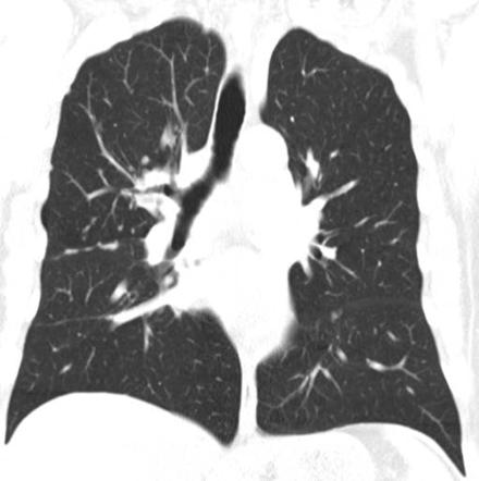 Sarcoidosis (thoracic manifestations) | Radiology Reference Article ...