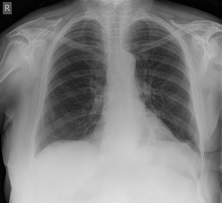 Breast cancer rib metastasis | Radiology Case | Radiopaedia.org