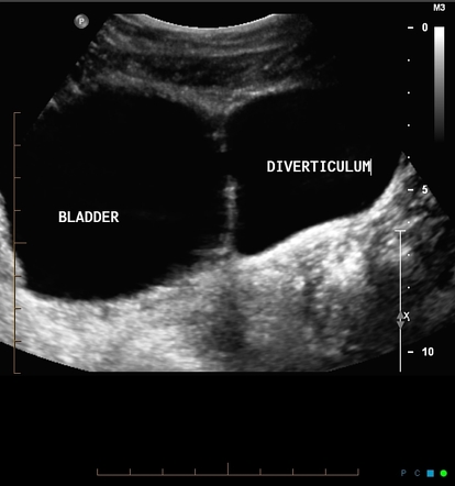 MRI artifact (flow void between urinary bladder and bladder ...