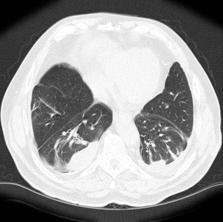 Comet tail sign (chest) | Radiology Reference Article | Radiopaedia.org