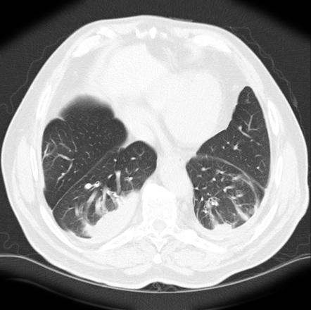 radiopaedia atelectasis radiology