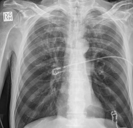 Left lower lobe collapse | Radiology Case | Radiopaedia.org