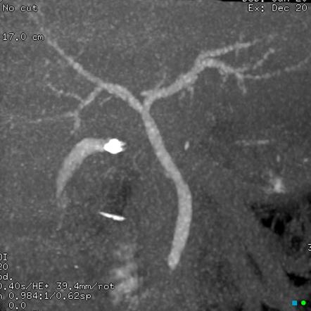 CT cholangiography (protocol) | Radiology Reference Article ...