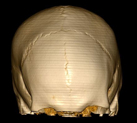 suture metopic radiopaedia radiology