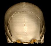 pterygopalatin sütür