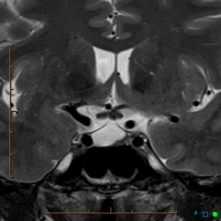 Growing Rathke's cleft cyst | Image | Radiopaedia.org