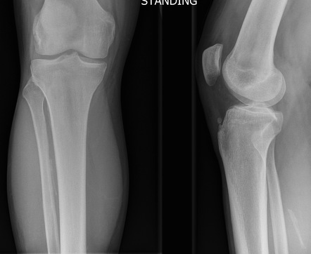 Normal Knee Radiograph With Skyline View | Image | Radiopaedia.org