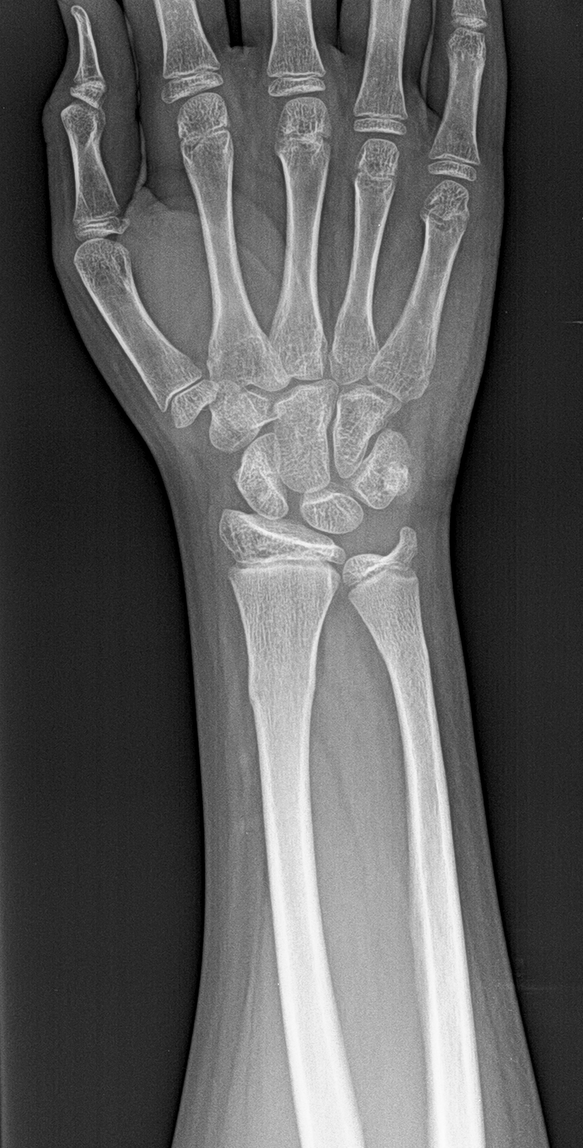 Torus fracture | Image | Radiopaedia.org