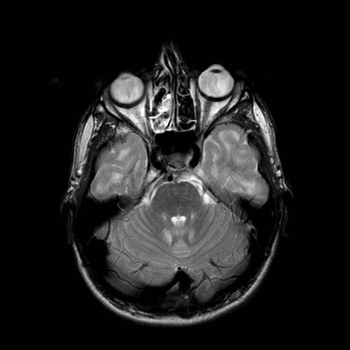 L-2-hydroxyglutaric aciduria | Image | Radiopaedia.org