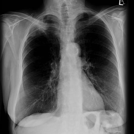 Apical non-small-cell lung cancer | Radiology Case | Radiopaedia.org