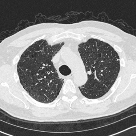 Steeple sign (trachea), Radiology Reference Article