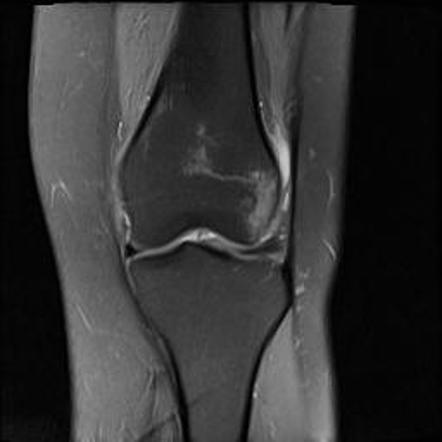 Transient Lateral Patellar Dislocation 