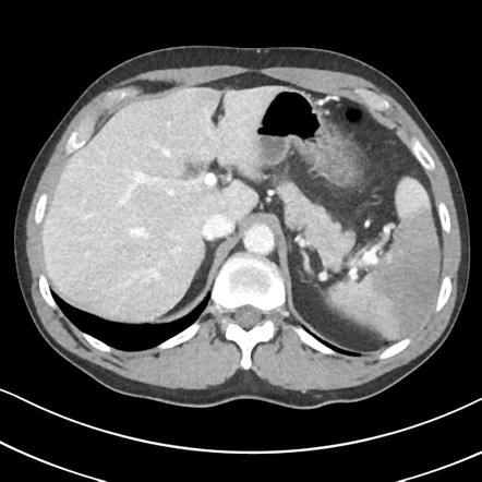 Splenic infarct | Radiology Case | Radiopaedia.org