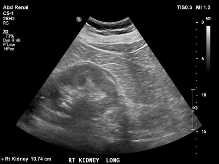 Normal kidneys | Radiology Case | Radiopaedia.org