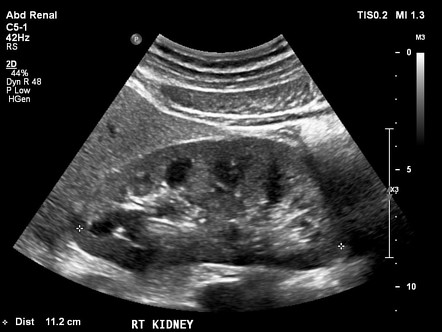 Kidneys | Radiology Reference Article | Radiopaedia.org