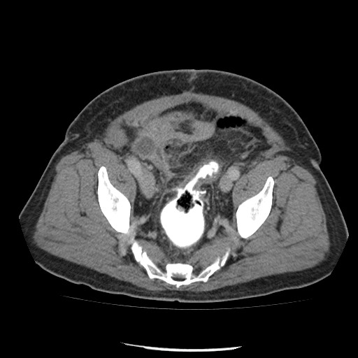 Colorectal anastomosis leakage | Image | Radiopaedia.org