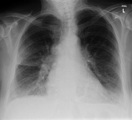 Unilateral Pulmonary Edema 