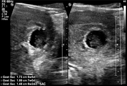 First trimester oligohydramnios | Image | Radiopaedia.org