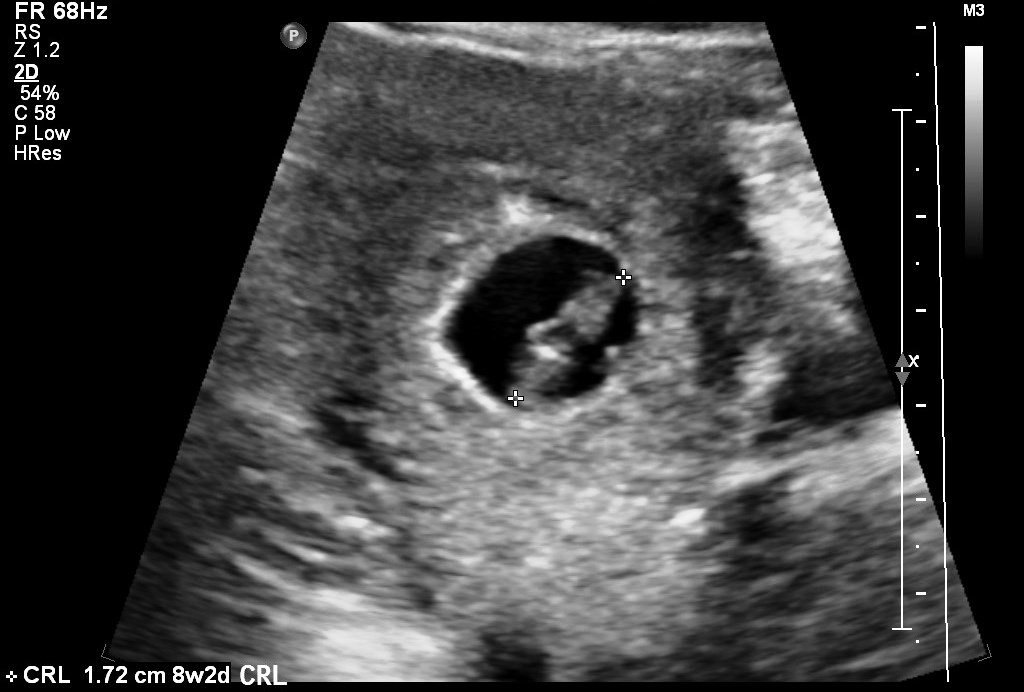 First trimester oligohydramnios | Image | Radiopaedia.org