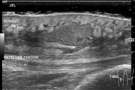 Subcutaneous Abscess Treatment