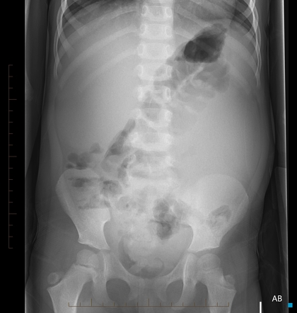 Wilms tumor | Radiology Reference Article | Radiopaedia.org