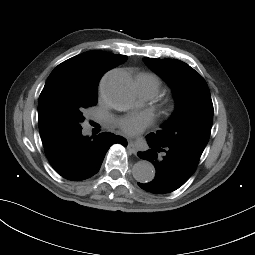 Aortic Intramural Hematoma 