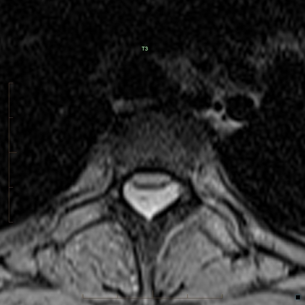 Spontaneous acute extradural hematoma of the thoracic spine | Image ...