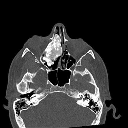 Craniofacial fibrous dysplasia | Radiology Reference Article ...