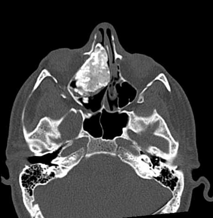 Paranasal sinus osteoma | Radiology Reference Article | Radiopaedia.org