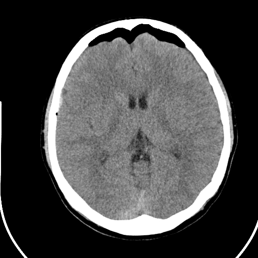 Post-traumatic tension pneumocephalus | Image | Radiopaedia.org