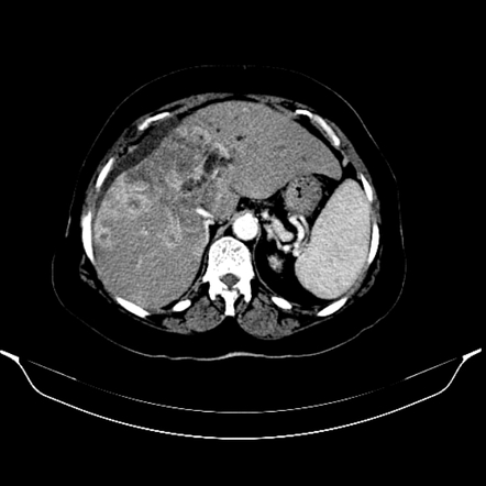 Playlist 'focal Liver Disease' By Nepean Radiology