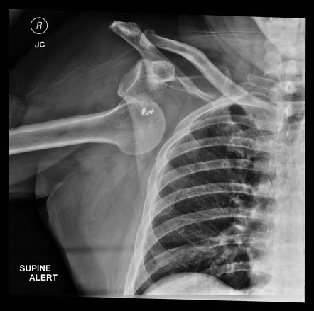 Anterior shoulder dislocation | Radiology Case | Radiopaedia.org