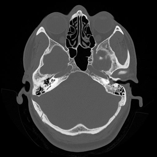 Sigmoid sinus wall dehiscence | Image | Radiopaedia.org