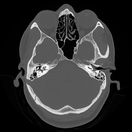 Sigmoid sinus diverticulum | Radiology Reference Article | Radiopaedia.org