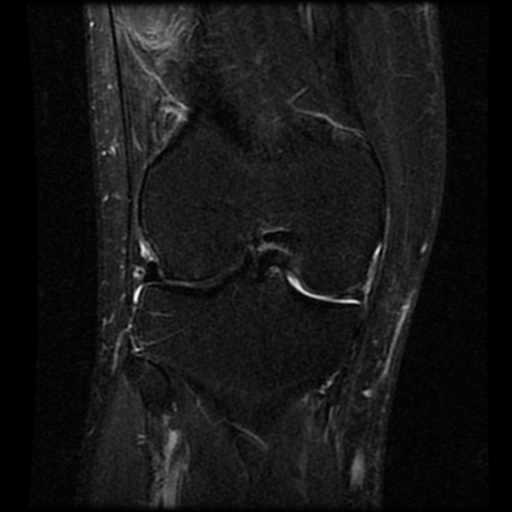 Double PCL sign | Image | Radiopaedia.org