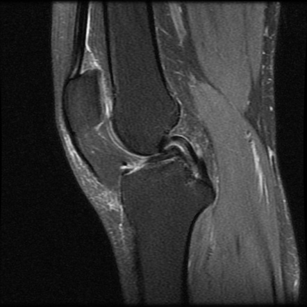 Double PCL sign | Image | Radiopaedia.org