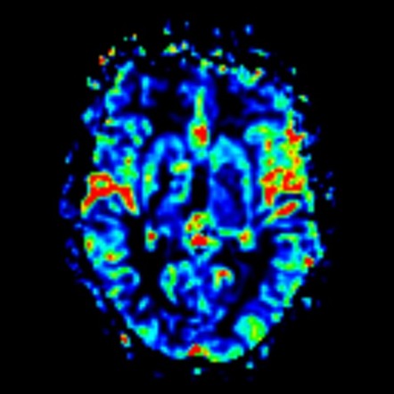 Glioblastoma IDH wild-type (thalamic with pseudoprogression) | Image ...