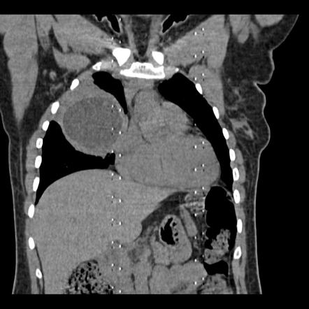 Hydatid cyst - lung | Radiology Case | Radiopaedia.org